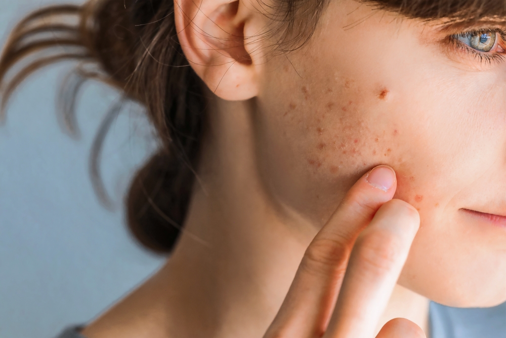 Woman with red cheeks- diathesis or allergy symptoms