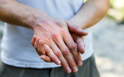 Exploring the Link Between Mental Health and Skin Conditions