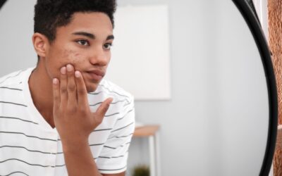 From Teen Years to Adulthood: Understanding the Lifecycle of Acne
