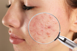 Teenage girl with acne problem