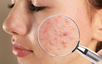 Real Stories: Triumphs Over Acne with Tailored Treatments