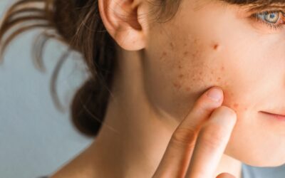 Unveiling the Environmental Impact of Acne Treatments: Insights from OMNIA TeleHEALTH