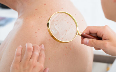 Beyond the Face: Treating Acne on the Back and Chest