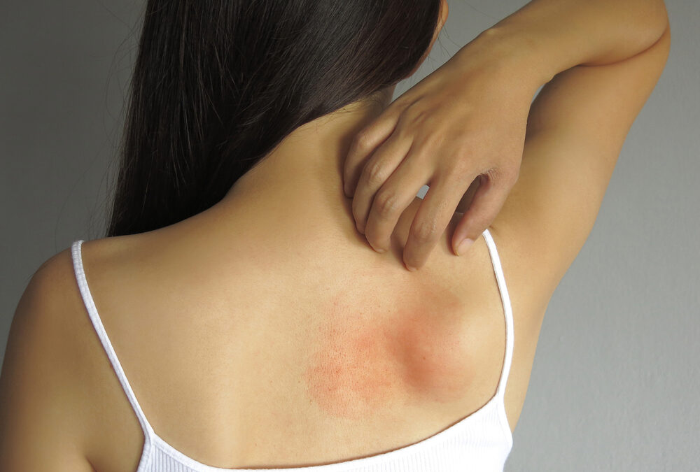 Preventing and Treating Post-Workout Skin Breakouts