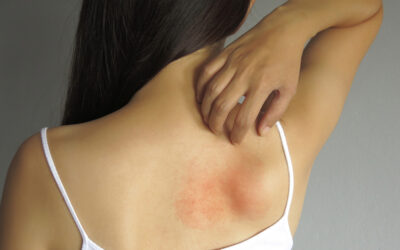 Preventing and Treating Post-Workout Skin Breakouts