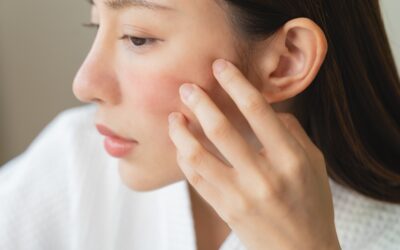 Understanding the Role of Genetics in Early-Onset Acne