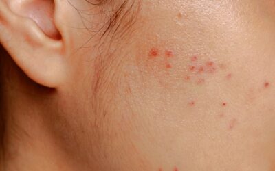 Caring for Your Skin: Post-Acne Scar Treatments and Solutions