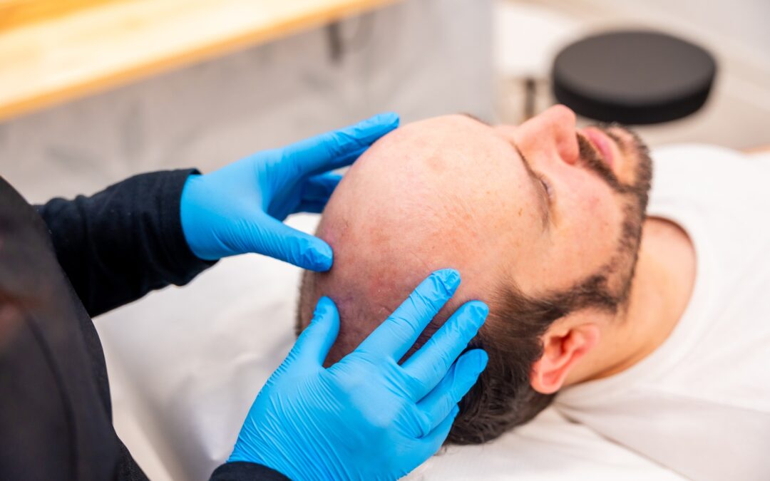 Navigating Hair Loss: Effective Treatments and What You Need to Know