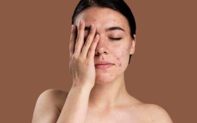 Your Complete Guide to Acne Treatment and Prevention
