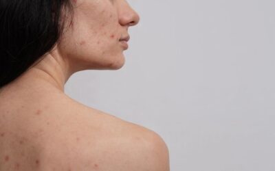 Treating Chest and Back Acne: Your Complete Guide