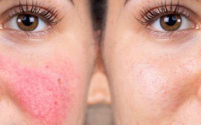 Rosacea or Acne? How Virtual Care Finds the Difference