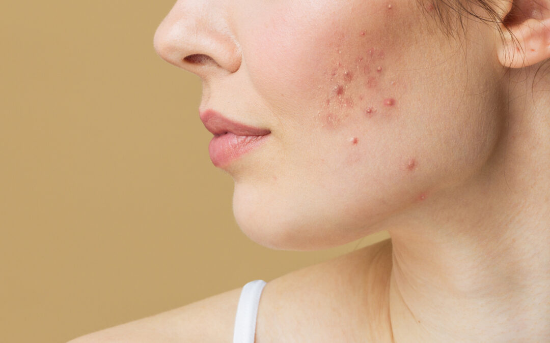 Hormonal Acne Diagnosis and Treatment Online
